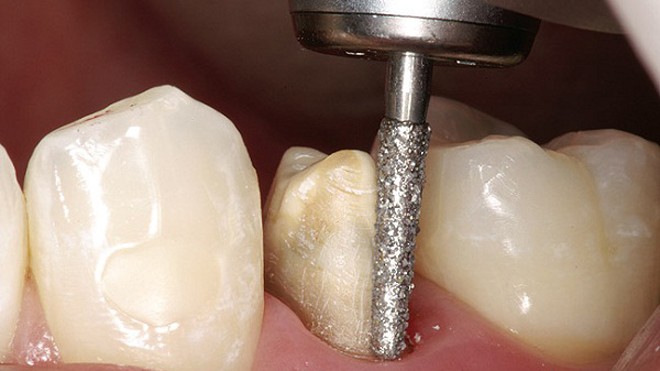 Mài răng một cách thô bạo là công đoạn không thể thiếu trong quá trình bọc răng sứ theo phương pháp cũ