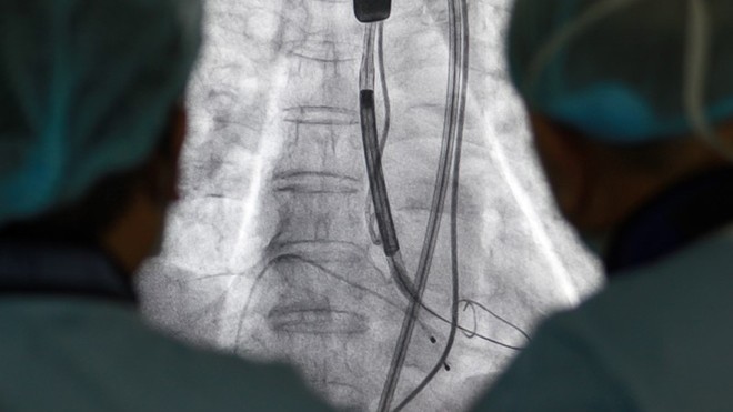 Ống thông được luồn qua da từ động mạch đùi đến động mạch chủ để thay van tim cho bệnh nhân