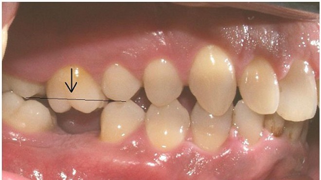 Mất răng cấm cần được trồng lại răng giả sớm
