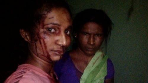 Meshram mặt đầy máu khi vào viện cấp cứu vì đánh nhau với hổ. Ảnh: BBC.