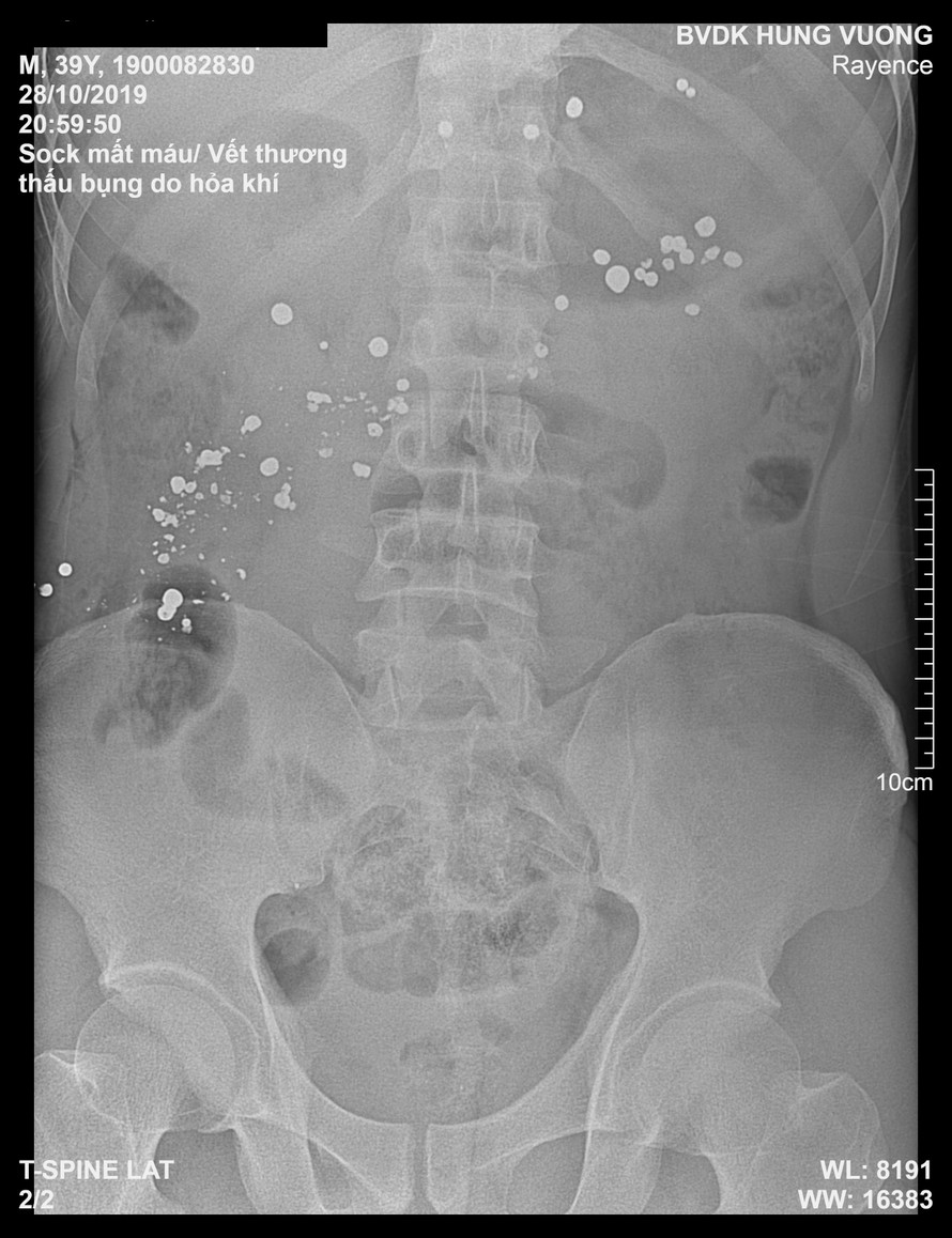 Ảnh chụp X quang bệnh nhân có nhiều dị vật kim khí cản quang trong ổ bụng.