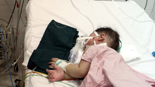 Phải hỗ trợ ôxy cho trẻ bị bệnh sởi tại Bệnh viện Nhi T.Ư. ẢNH: NHƯ Ý