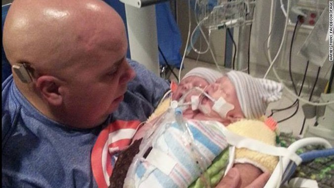 Michael Hamby, bố của cặp song sinh liền thân, bế con tại bệnh viện. Ảnh:CNN.