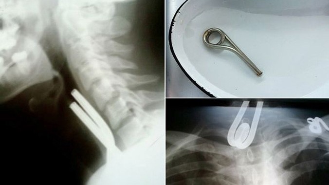 Ảnh chụp X-quang bệnh nhân khó thở vì chốt sắt nằm chắn trong cổ họng.