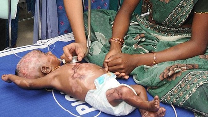 Cậu bé Rahul nhập viện hồi tháng 8-2013. Ảnh: Daily Mail.