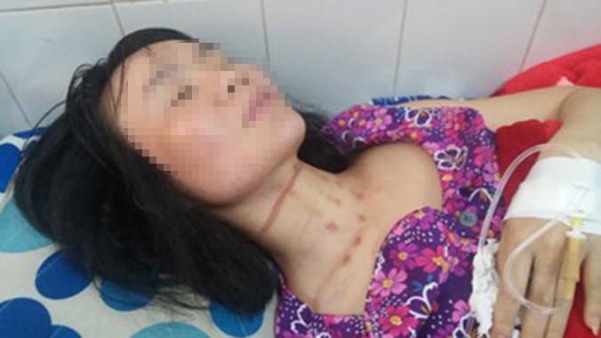 Chị Linh đang được điều trị tại Bệnh viện Đa khoa tỉnh Gia Lai, trên cổ còn nhiều vết bầm tím.
