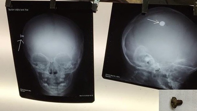 Hình ảnh chiếc đinh vít (đốm trắng) trên phim X quang hộp sọ chụp thẳng và chụp nghiêng và sau khi được gắp ra khỏi đầu bệnh nhi (ảnh dưới phải). Ảnh do bác sĩ cung cấp.