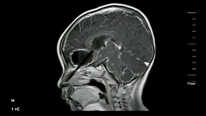 Ảnh chụp X-Quang đoạn đũa mắc trong não cậu bé.