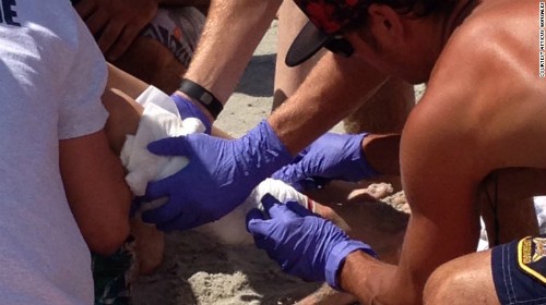 Cậu bé 10 tuổi bị cá mập cắn vào bắp chân. Ảnh: CNN.