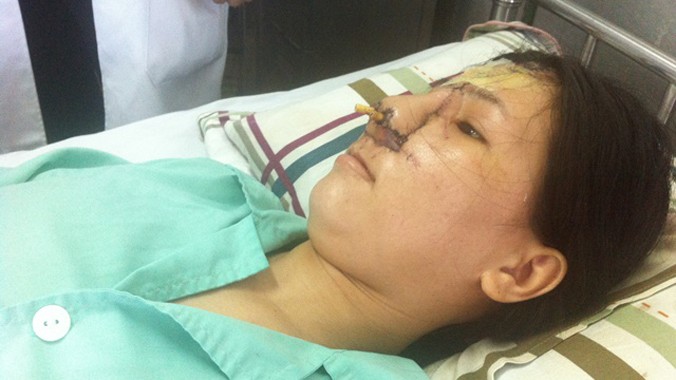 Chị Phú sau khi được phẫu thuật tái tạo gương mặt do bị bom nổ. Ảnh: Quốc Ngọc.