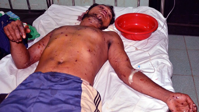Điểu Huy, người bị thương nặng nhất trong 4 nạn nhân vụ nổ quả đạn. Ảnh: Minh Hưng.