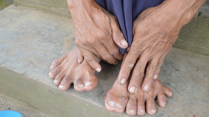 Đôi tay và 2 bàn chân của ông Hảo có tổng cộng 25 ngón.