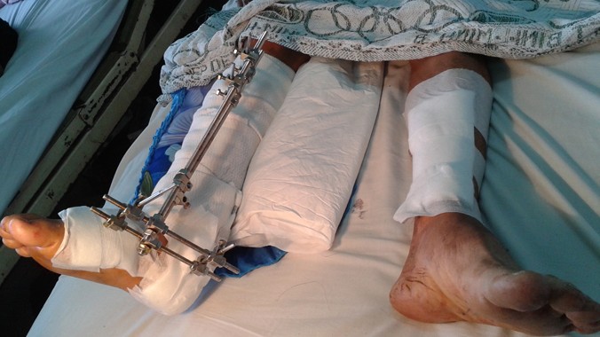 Ông N. đã được phẫu thuật nối lại chân sau 10 ngày nhập viện.