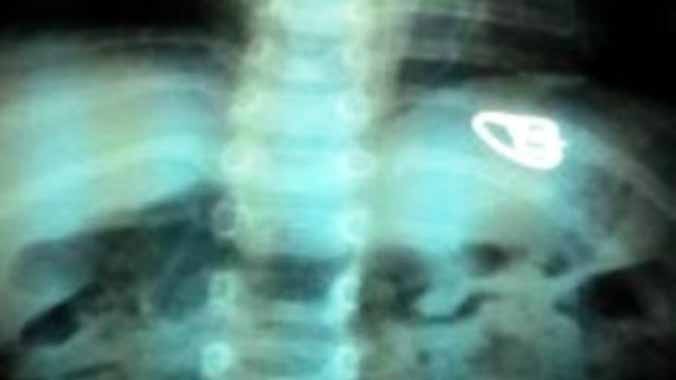 Phim X-quang cho thấy chiếc nhẫn nằm trong đường tiêu hóa bệnh nhi.