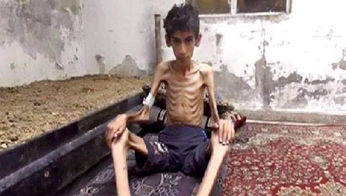 Một nạn nhân của nạn đói ở Madaya. Ảnh: Breibart.