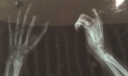Ảnh X-quang ngón tay trỏ trái bị cắt lìa của Xiaopeng. Ảnh: dailyreadlist.