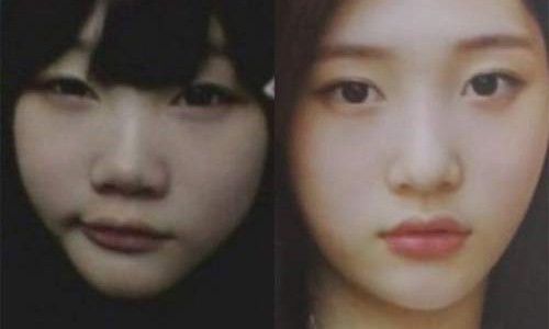 Jung Chae Yeon trước và sau khi thẩm mỹ.