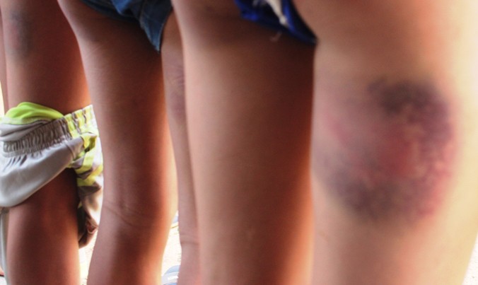 Vết bầm tím vẫn còn hằn trên da thịt học sinh lớp 7/1 sau 3 ngày bị đánh.