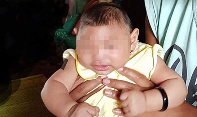 Bé gái 4 tháng tuổi ở Đắk Lắk là ca mắc hội chứng đầu nhỏ do vi rút Zika đầu tiên tại Việt Nam. Ảnh: VTC.