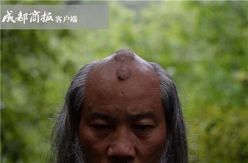 Đầu ông Hà Đạo Quân nổi nốt chai do nhiều năm luyện Thiết Đầu Công. Ảnh: Chengdu Shangbao.