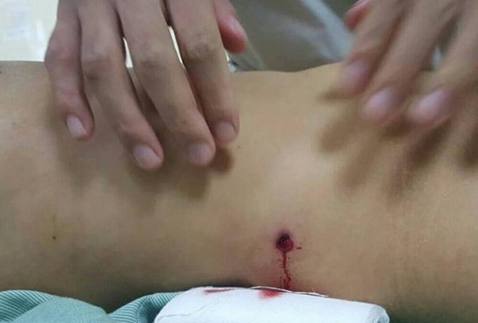 Hình ảnh viên đạn đâm vào bụng bệnh nhân. Nguồn: Bệnh viện E.