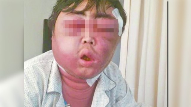 Anh Zhang phải nhập viện vì muỗi đốt