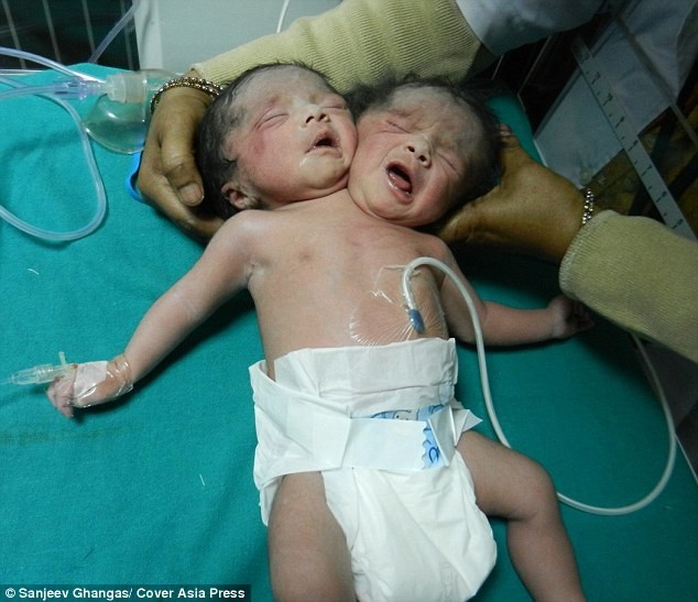 Bé sơ sinh hai đầu chào đời tại Bangladest