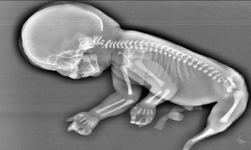 Hình ảnh siêu âm cho thấy thai nhi có chiếc đuôi dài như đuôi cá. Ảnh: Twitter.
