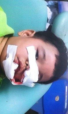 Bé 3 tuổi bị chó Phú Quốc cắn phải khâu 200 mũi trên mặt.