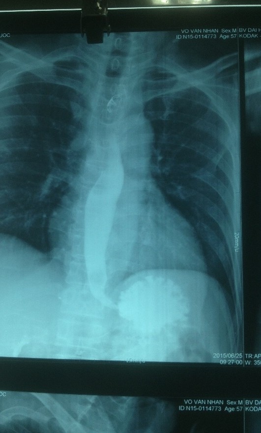 Hình X-quang kiểm tra thực quản sau phẫu thuật. Ảnh do bệnh viện cung cấp.