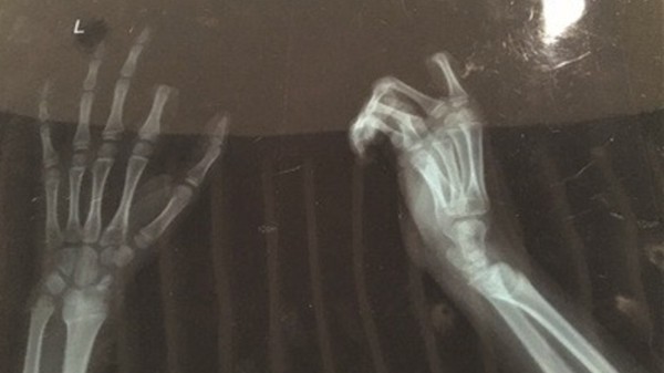 Ảnh chụp X-quang bàn tay bị đứt ngón của Peng.