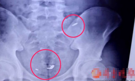 Phim chụp X-quang khoang bụng thiếu niên Wang.