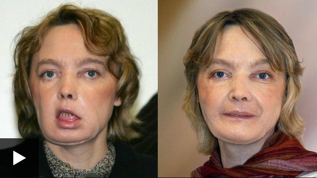 Hình ảnh Isabelle Dinoire sau (trái) và trước phẫu thuật.