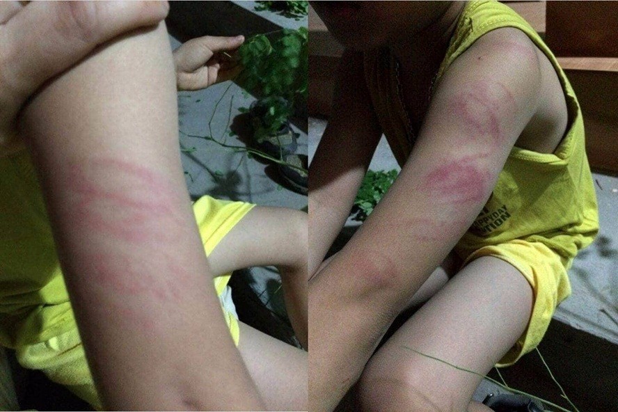 Hình ảnh vết bị đánh bầm tím trên tay của học sinh Đỗ T.A được gia đình ghi lại. Ảnh: GĐCC