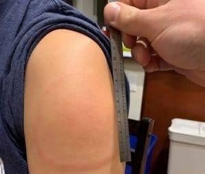 Vắc xin Moderna và phản ứng 'cánh tay COVID'