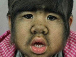 Em bé 4 tuổi mang gương mặt 'người sói'