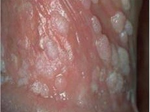 Nam giới nhiễm virus HPV cũng tương đối phổ biến