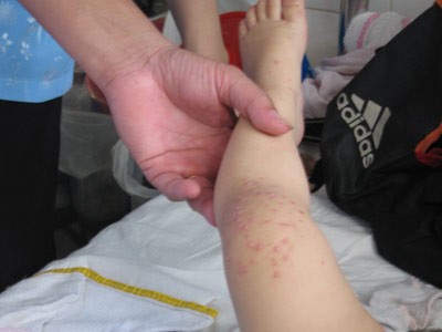 Bệnh nhi tử vong sau 68 ngày điều trị bệnh tay chân miệng