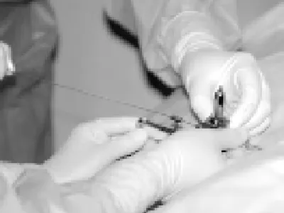 Cấy hạt phóng xạ I125 trong điều trị ung thư