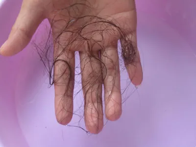 Tóc rụng nhiều có đáng lo?