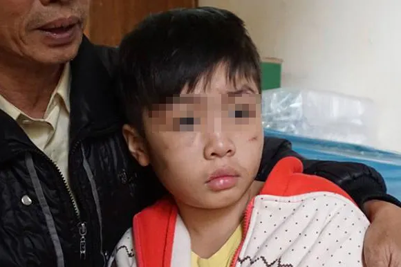Cháu K. với nhiều vết sẹo trên mặt.