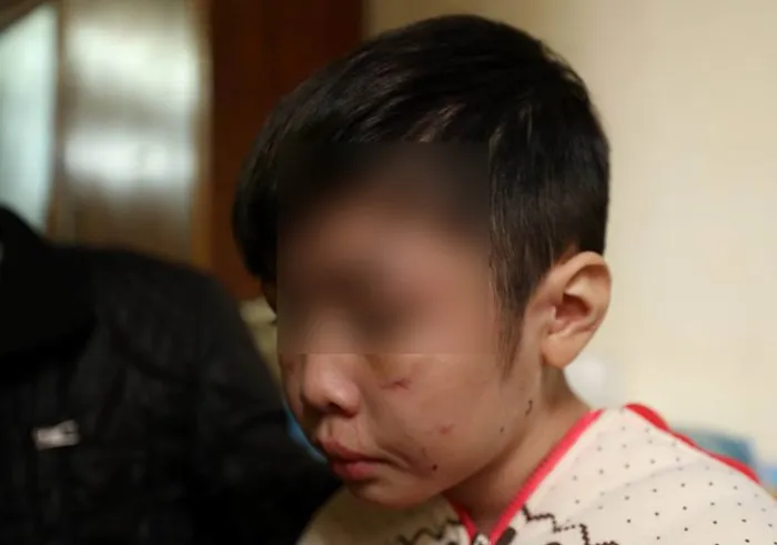 Gương mặt chằng chịt vết sẹo của bé K (Ảnh Đình Việt) 