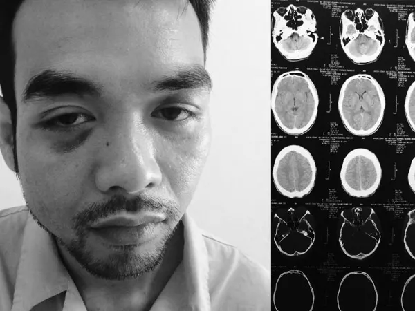 Đường Quang Anh đã bị một nhóm côn đồ dùng gậy chơi bi–a vụt khiến khuôn mặt bị biến dạng