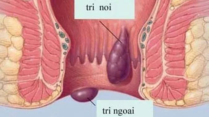 Trĩ độ 3: có cần phẫu thuật?