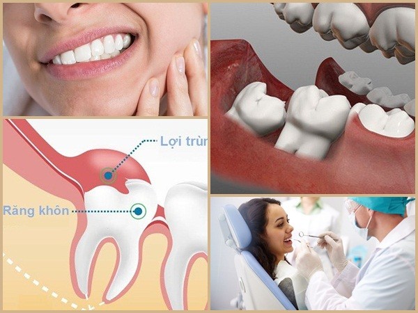 Đau răng khôn: Những điều quan trọng bạn cần biết